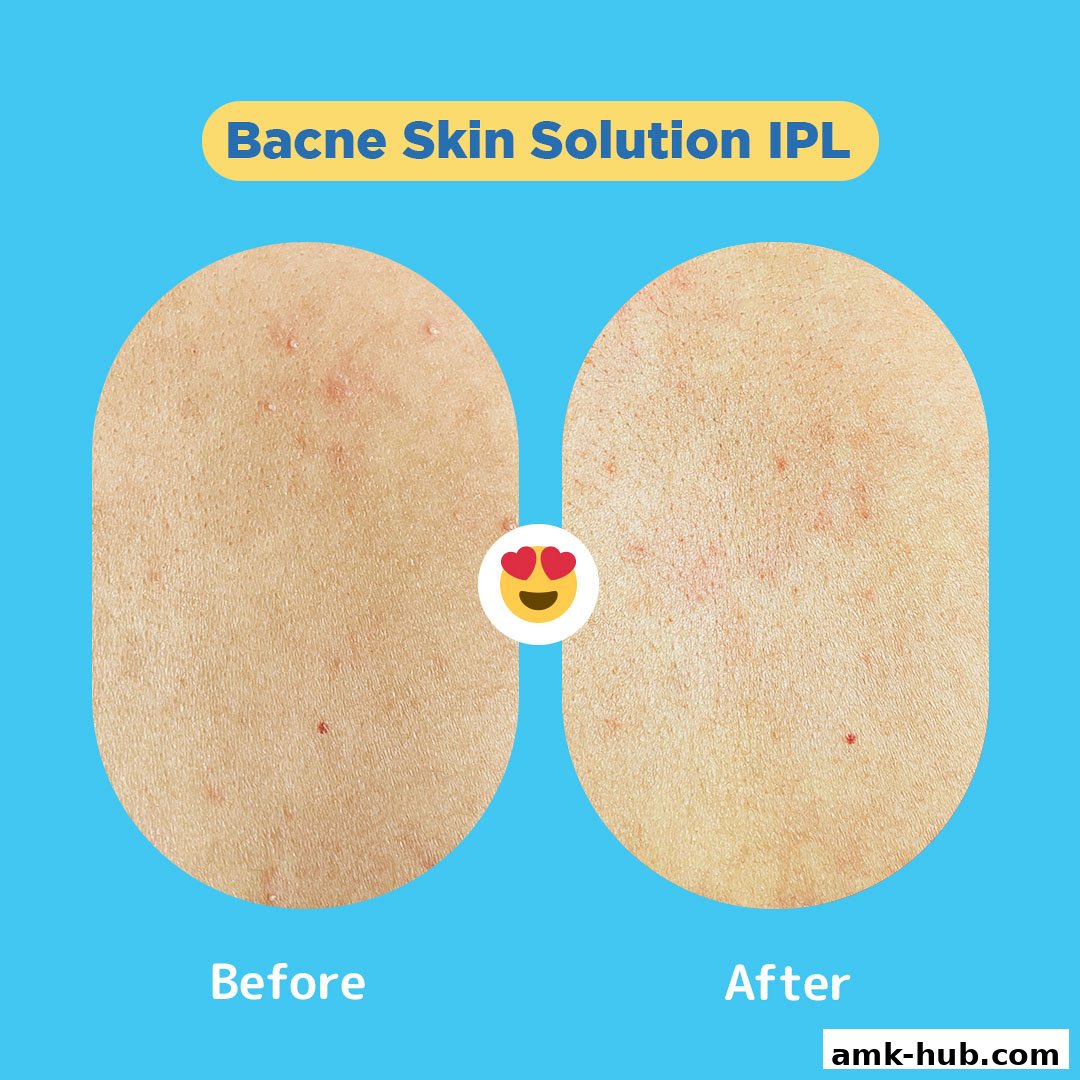 Before and after images showcasing a skin solution for acne.