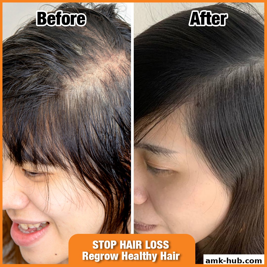 Before and after comparison of hair treatment showing hair regrowth and reduced hair loss.