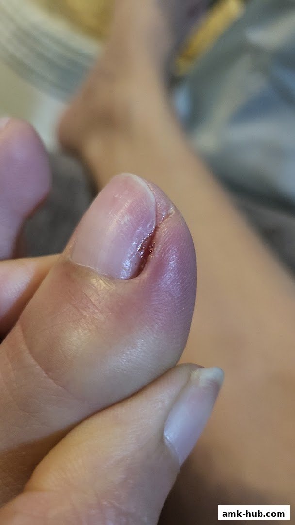 Close-up of a person's toe with an ingrown toenail and redness.