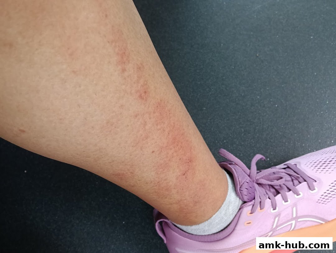 A close-up of a person's leg with a rash and a pink athletic shoe.