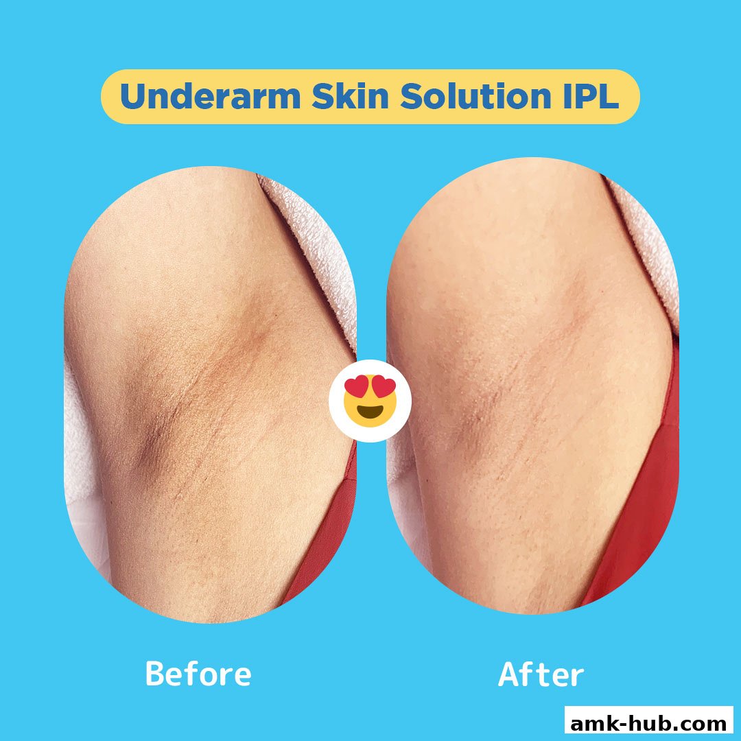 Before and after images showcasing underarm skin improvement with IPL treatment.