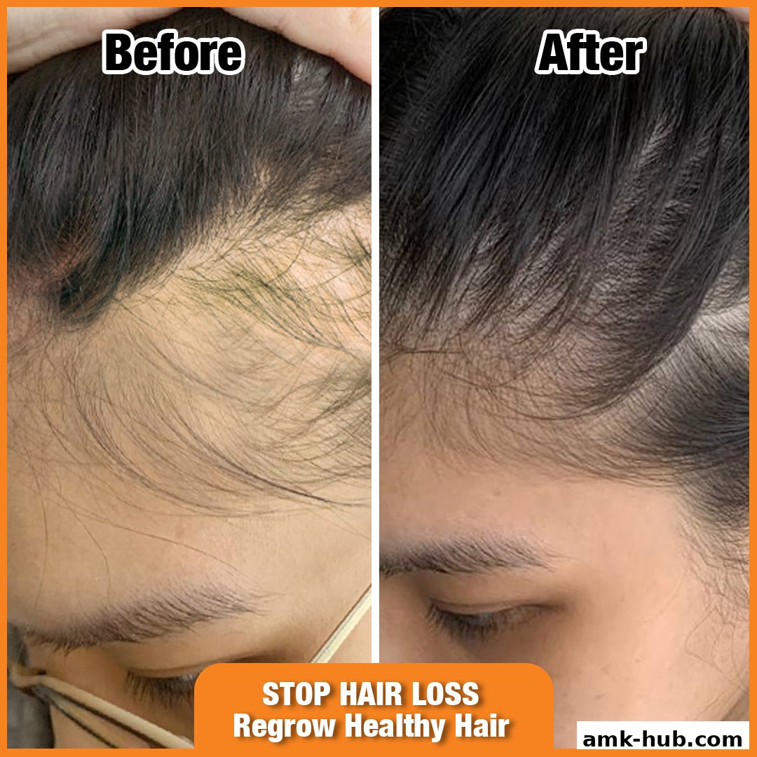 Before and after comparison of hair regrowth treatment for hair loss.