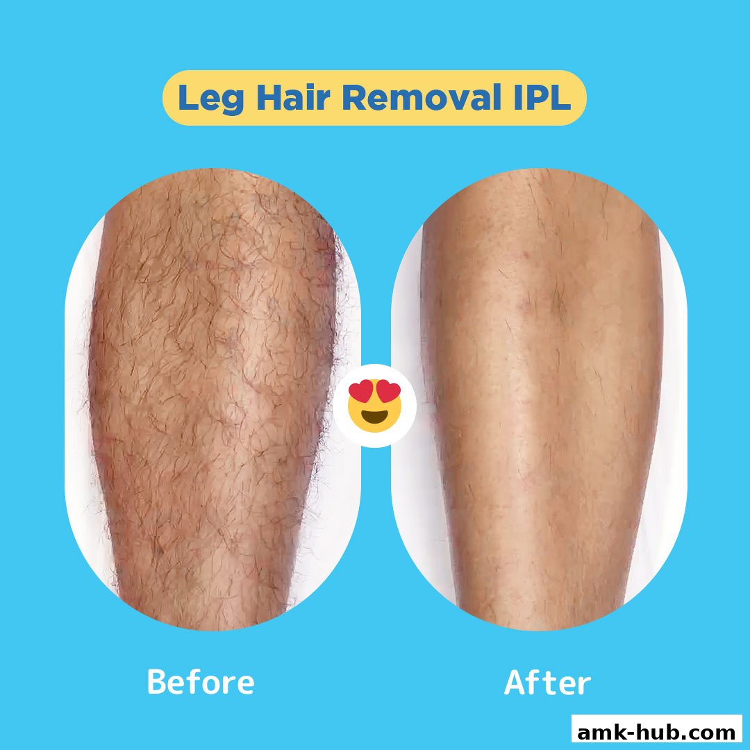 Before and after comparison of leg hair removal using IPL technology.