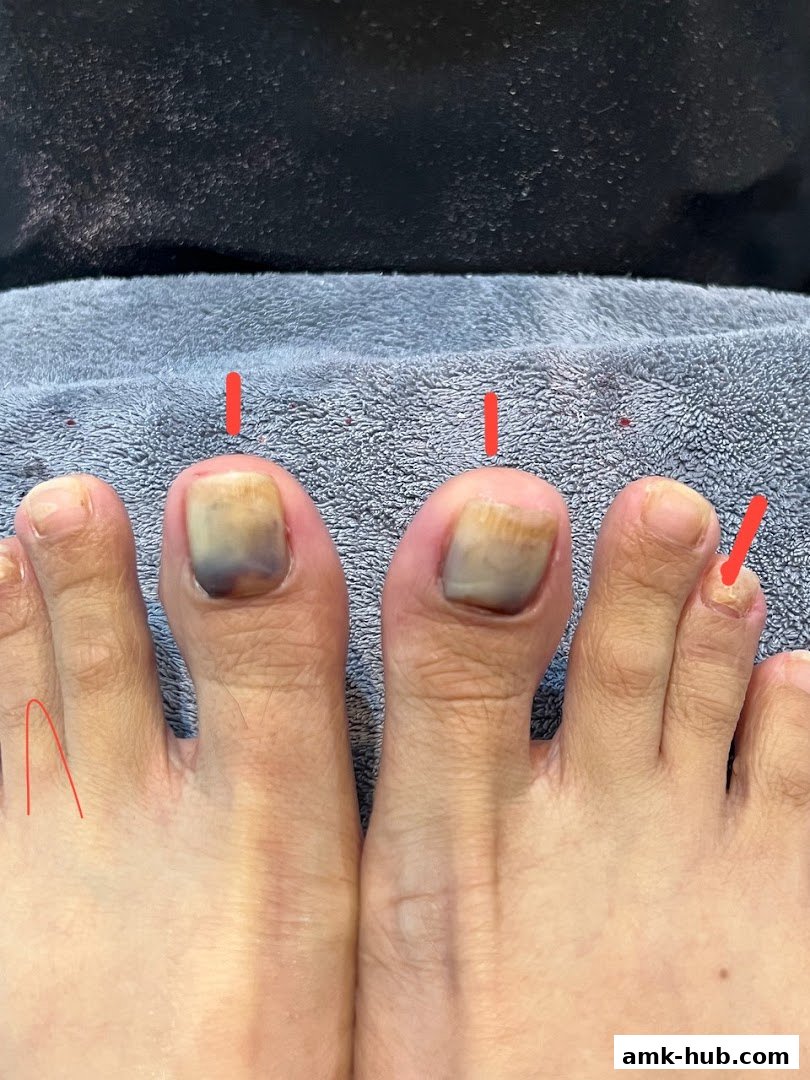 Close-up of toes with nail issues, marked with red lines.