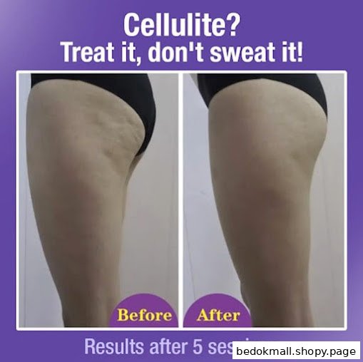 Before and after image of cellulite treatment results on a leg.