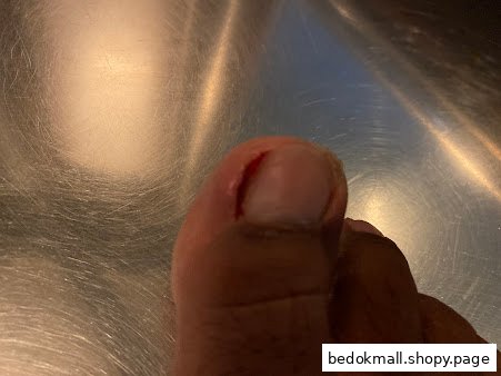 Close-up of a human toe with a damaged or ingrown toenail.