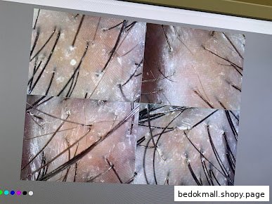 Magnified view of a scalp with hair follicles and flakes displayed on a screen.