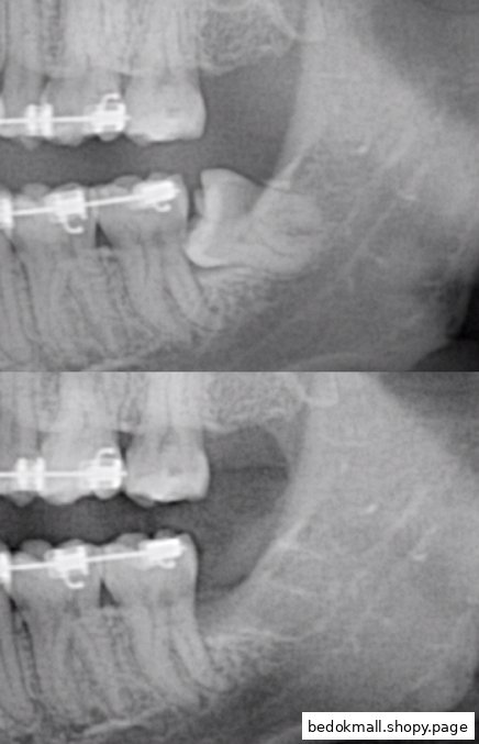 Two dental X-rays showing teeth with braces and an impacted wisdom tooth.