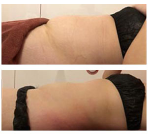 Before and after comparison of a person's midsection, showcasing slimming results.