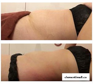 Before and after comparison of a person's midsection, showcasing slimming results.