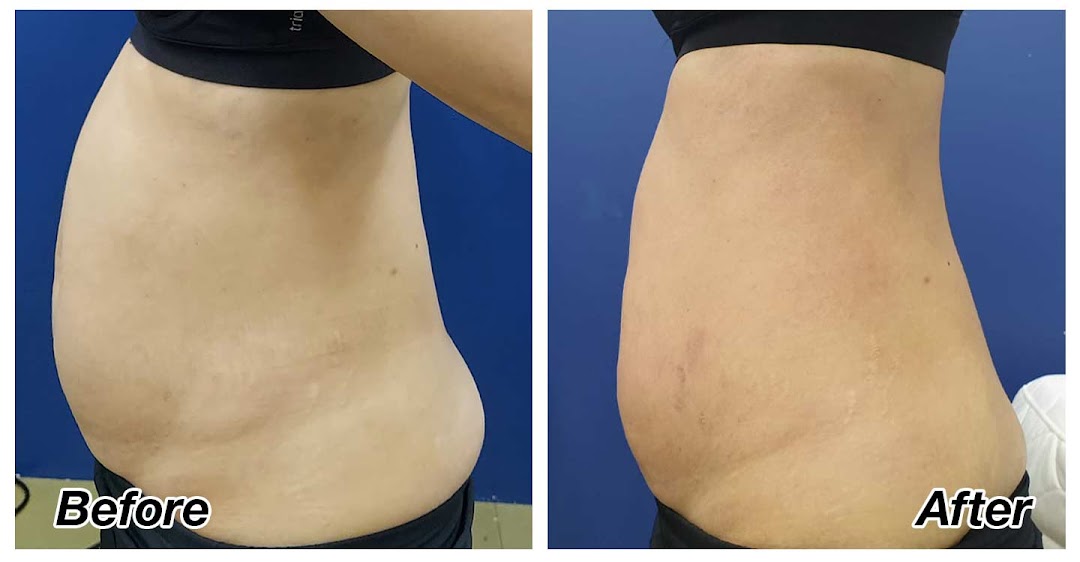 Before and after comparison of a person's midsection, demonstrating slimming results.
