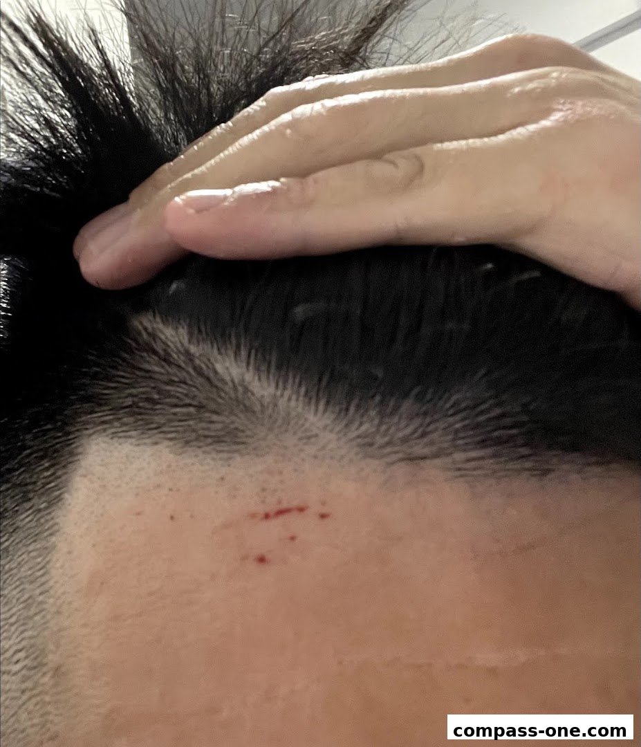 A close-up shot of a person's forehead with a hand touching their hair, showing a small cut.