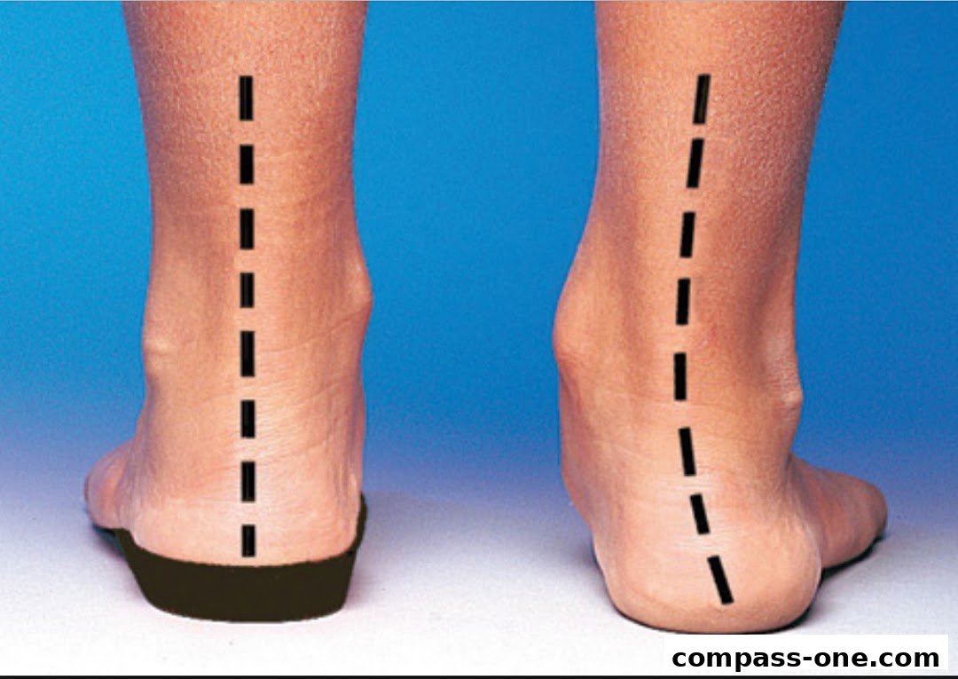 Comparison of feet alignment, one with an orthotic insert and one without.