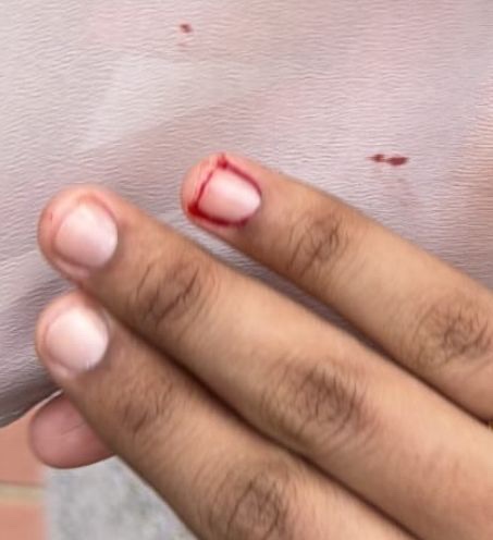 A close-up of a person's finger showing a cut near the nail, with visible blood.