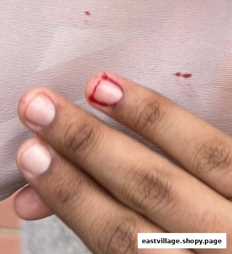 A close-up of a person's finger showing a cut near the nail, with visible blood.