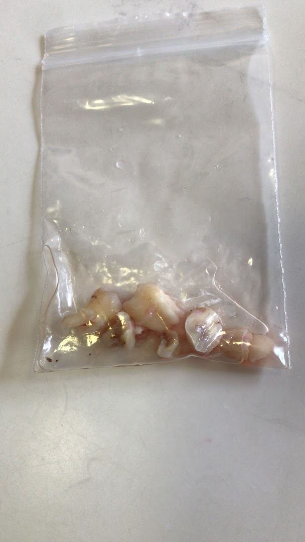 A clear plastic bag containing several extracted teeth, likely from a dental procedure.