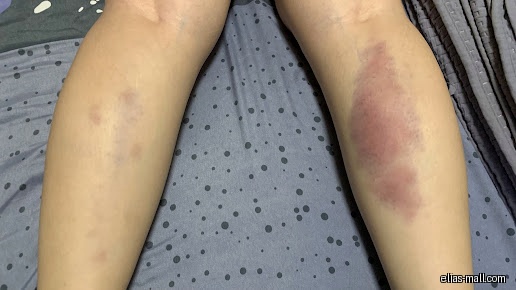 The image shows two legs, one with a large bruise.