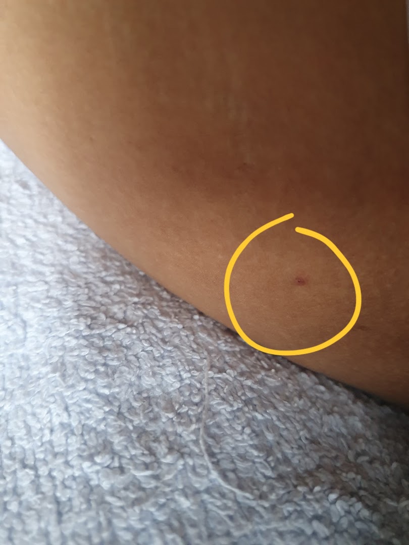 Close-up of skin with a small red mark highlighted by a yellow circle, possibly related to a skin treatment.