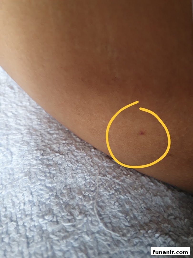 Close-up of skin with a small red mark highlighted by a yellow circle, possibly related to a skin treatment.