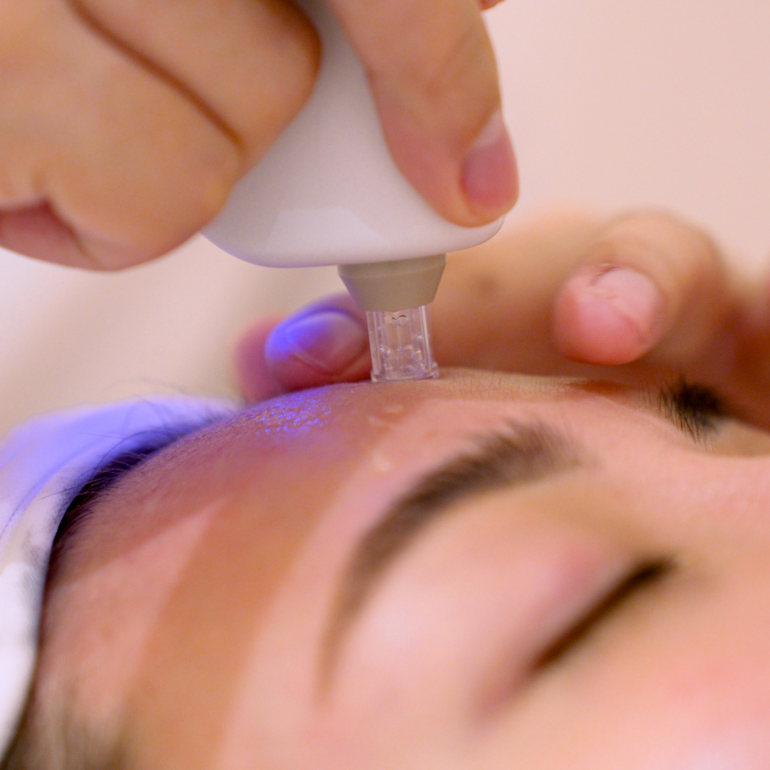 Close-up of a person receiving a facial treatment with a microneedling device at Skin Belief.