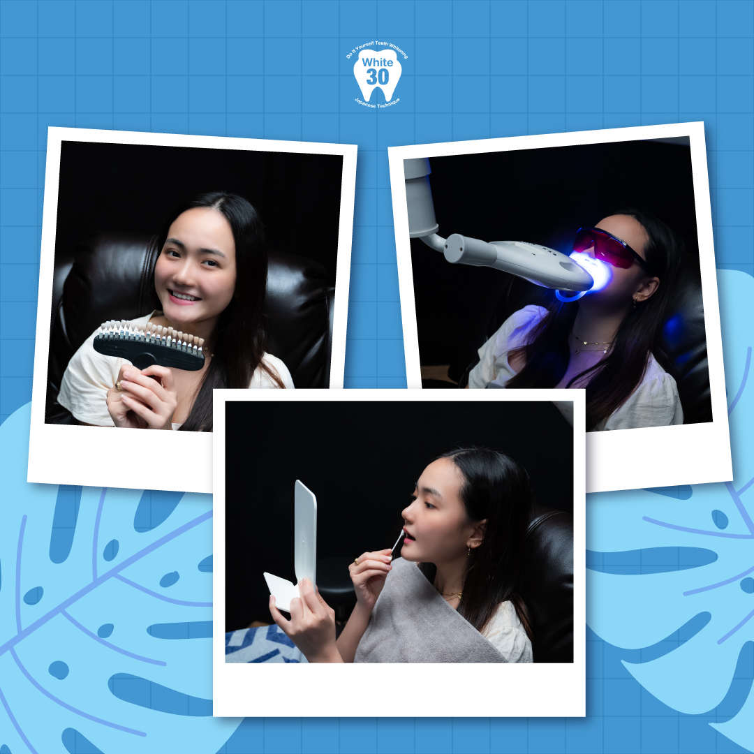 A collage showing a customer experiencing teeth whitening procedures at White30, highlighting the process and results.