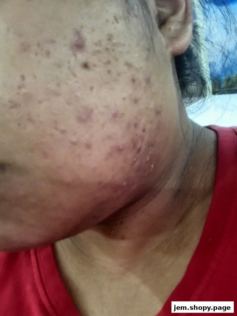 Close-up of a person's face showing acne and blemishes.