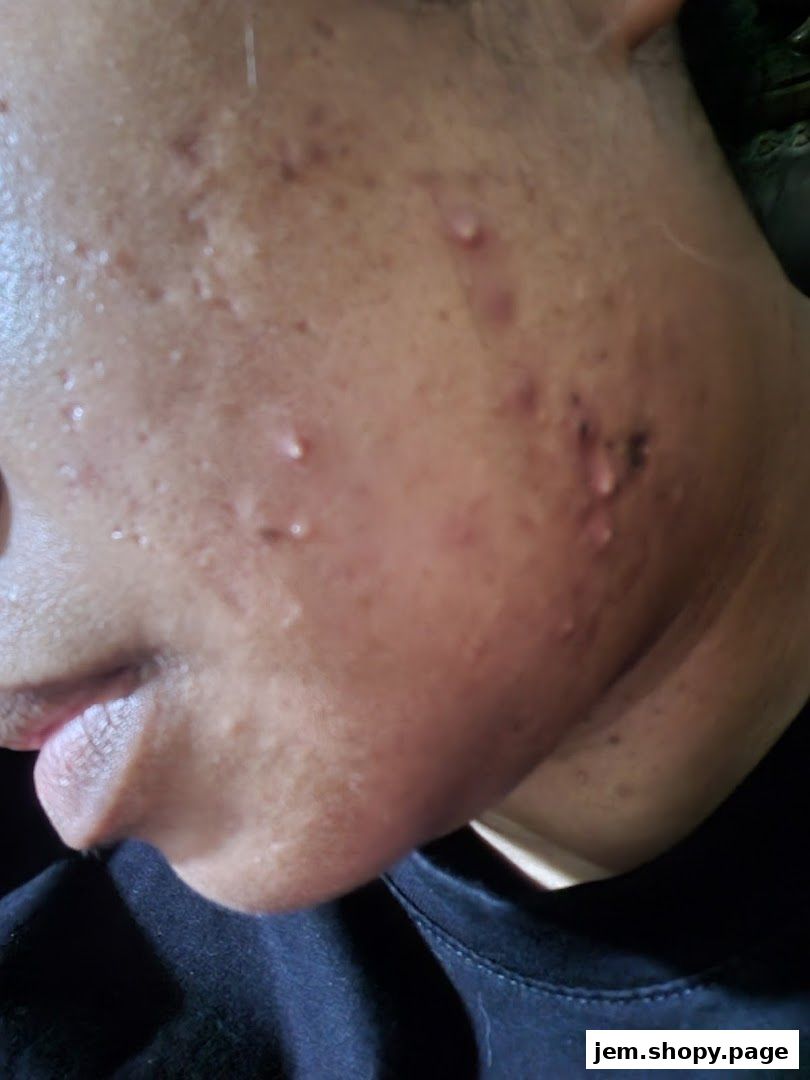 Close-up of a person's face showing acne and blemishes.