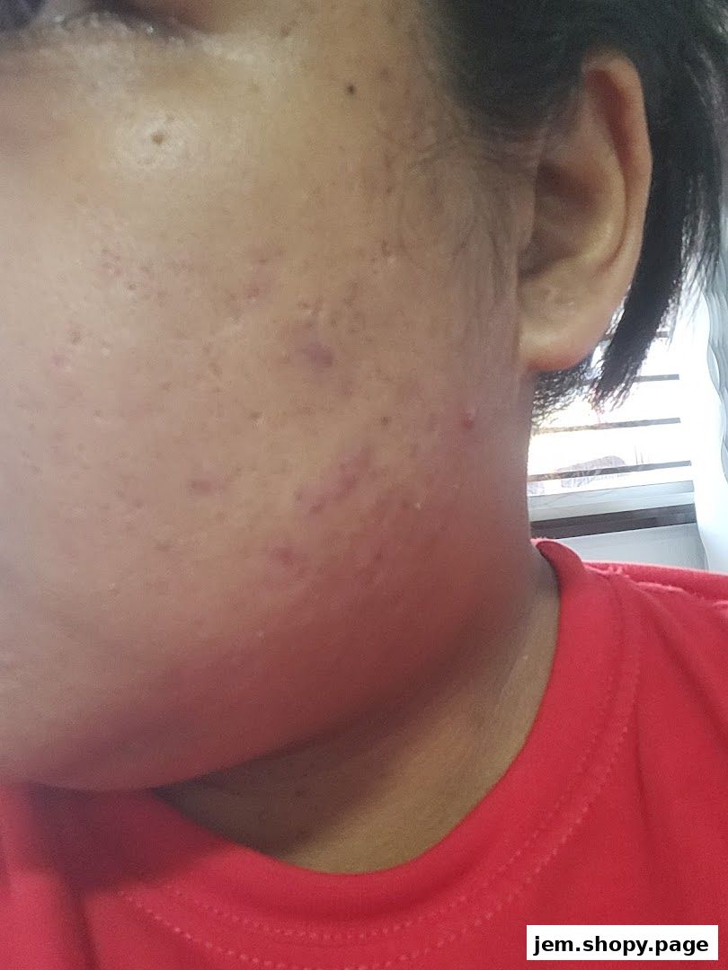 Close-up of a person's face showing acne and skin texture.