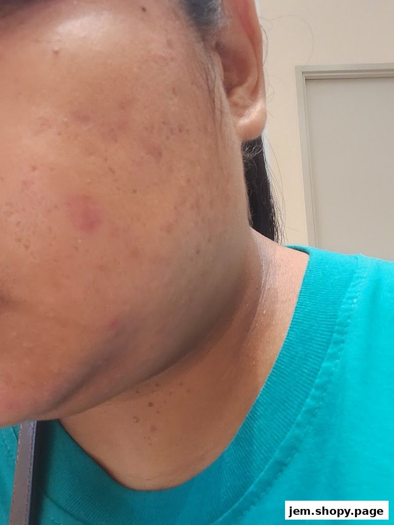 Close-up of a person's face showing acne and skin texture.