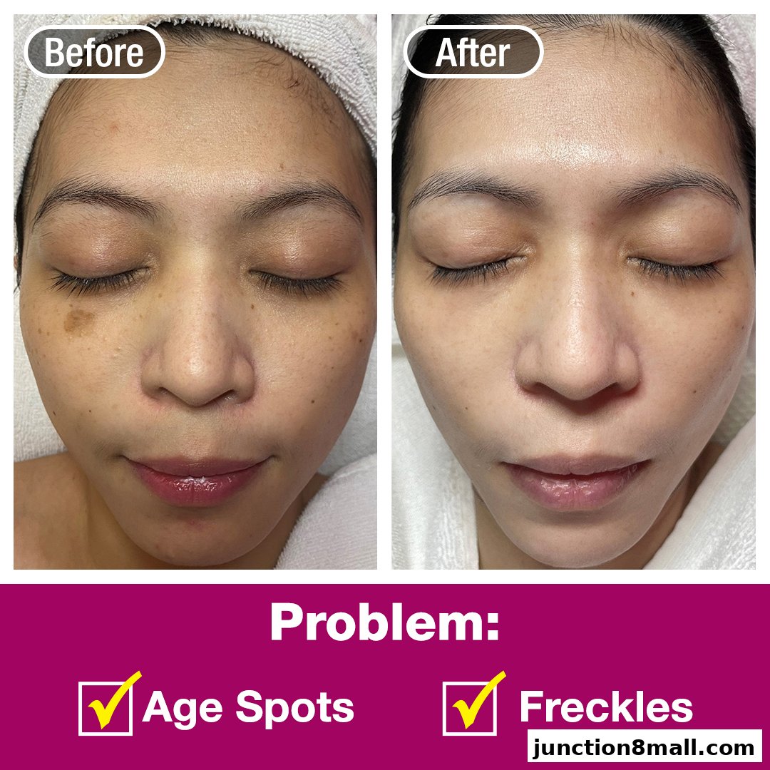 Before and after comparison of a woman's face showing treatment for age spots and freckles.
