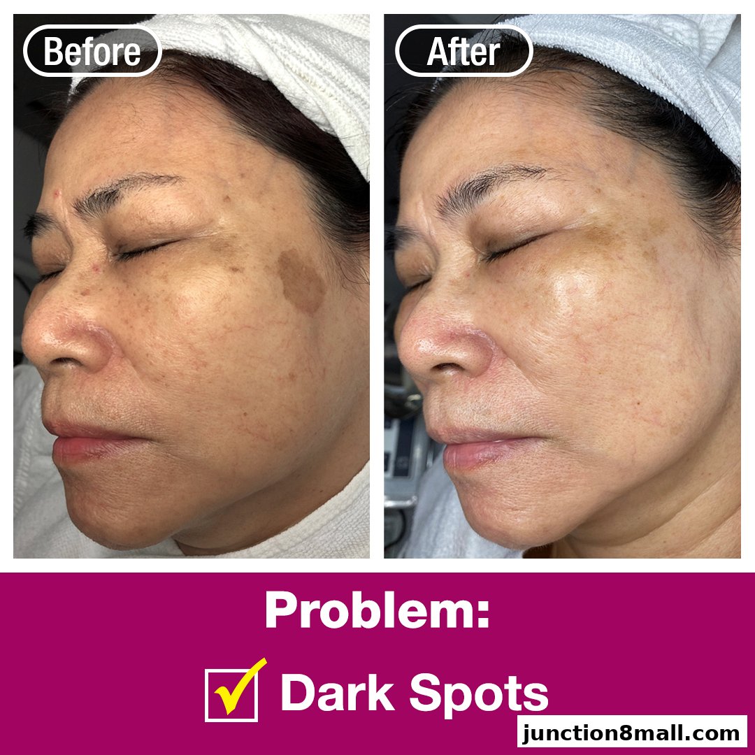 Before and after images showing a woman's face with dark spots treated.