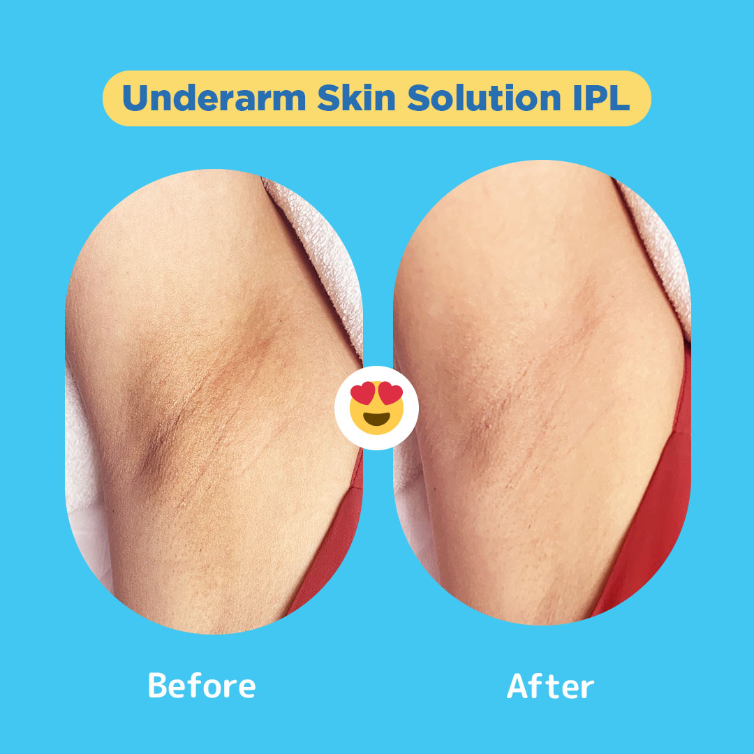 Before and after comparison of underarm skin, showcasing the results of IPL treatment.