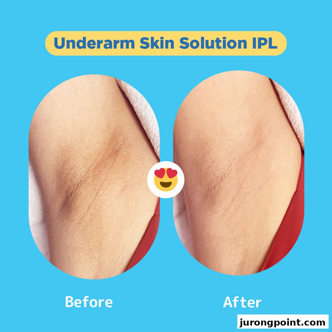 Before and after comparison of underarm skin, showcasing the results of IPL treatment.