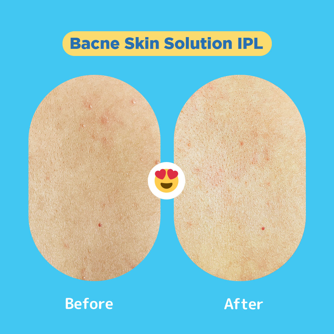 Image shows a 'before and after' comparison of skin treated with Bacne Skin Solution IPL.