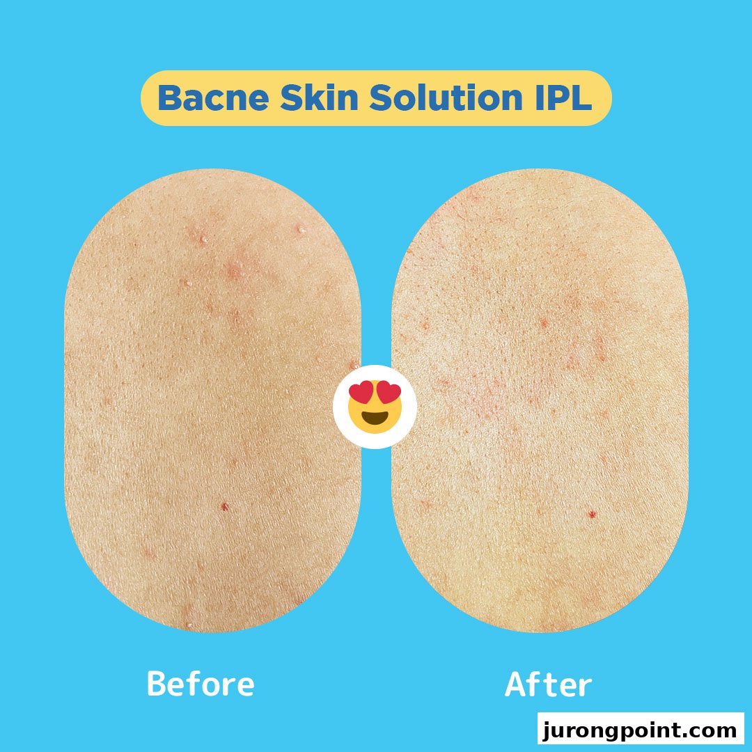 Image shows a 'before and after' comparison of skin treated with Bacne Skin Solution IPL.
