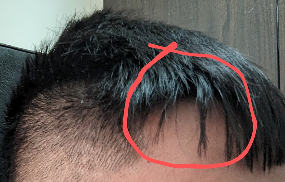 Close-up of a person's hair and scalp, highlighting a section with a red circle.