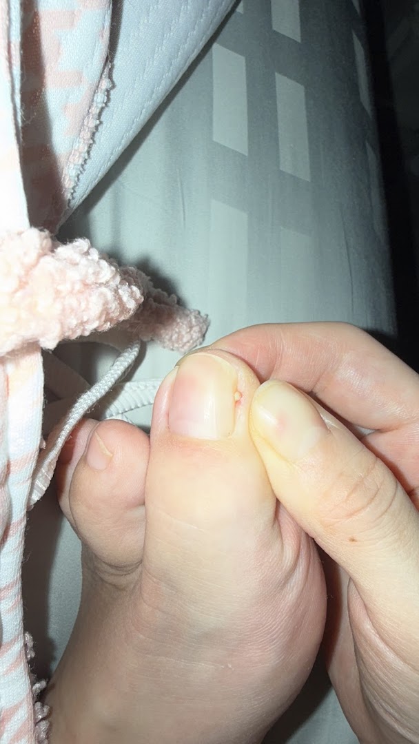 A close-up of a person's foot and hand, showing a toe with a small bump near the nail.