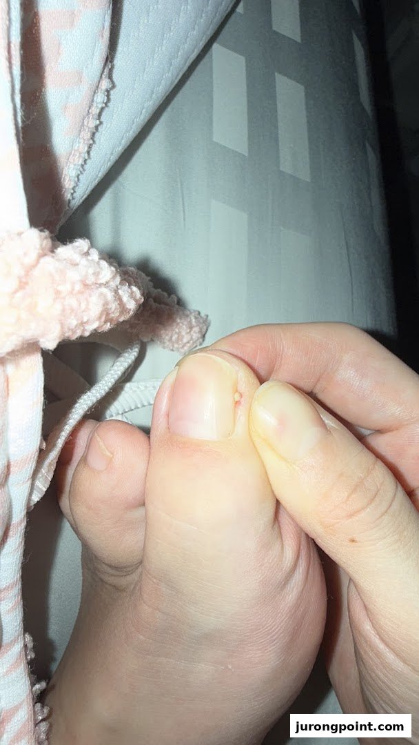 A close-up of a person's foot and hand, showing a toe with a small bump near the nail.