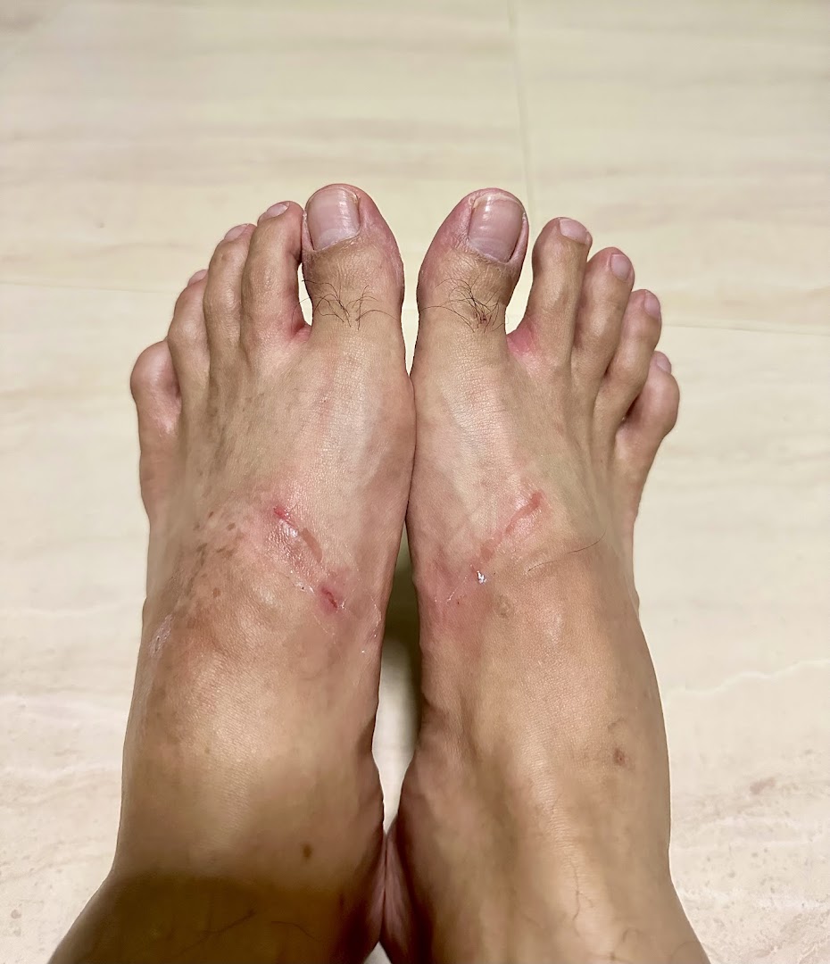 A close-up view of a pair of feet showing skin irritation and marks.