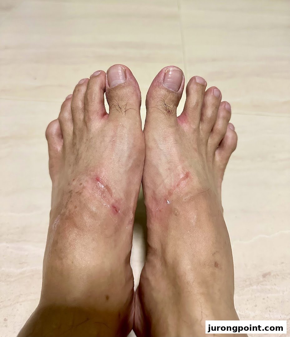 A close-up view of a pair of feet showing skin irritation and marks.