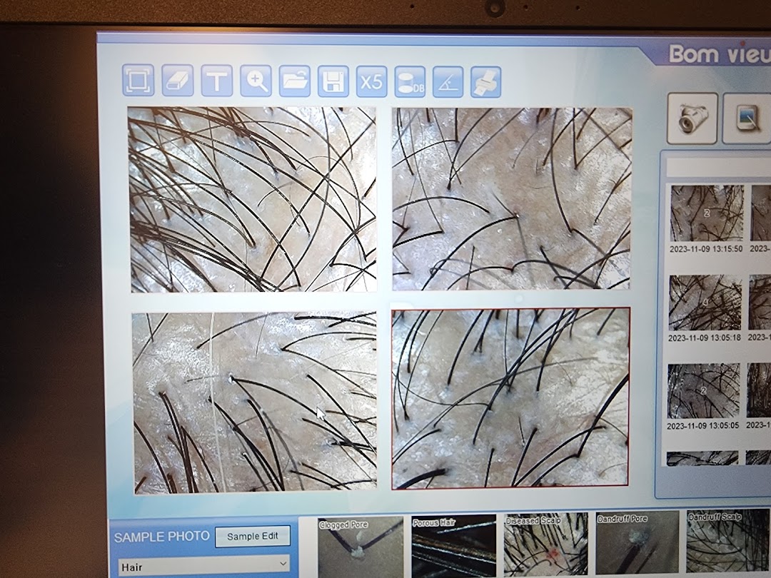 A computer screen displaying magnified images of a scalp and hair for detailed analysis.