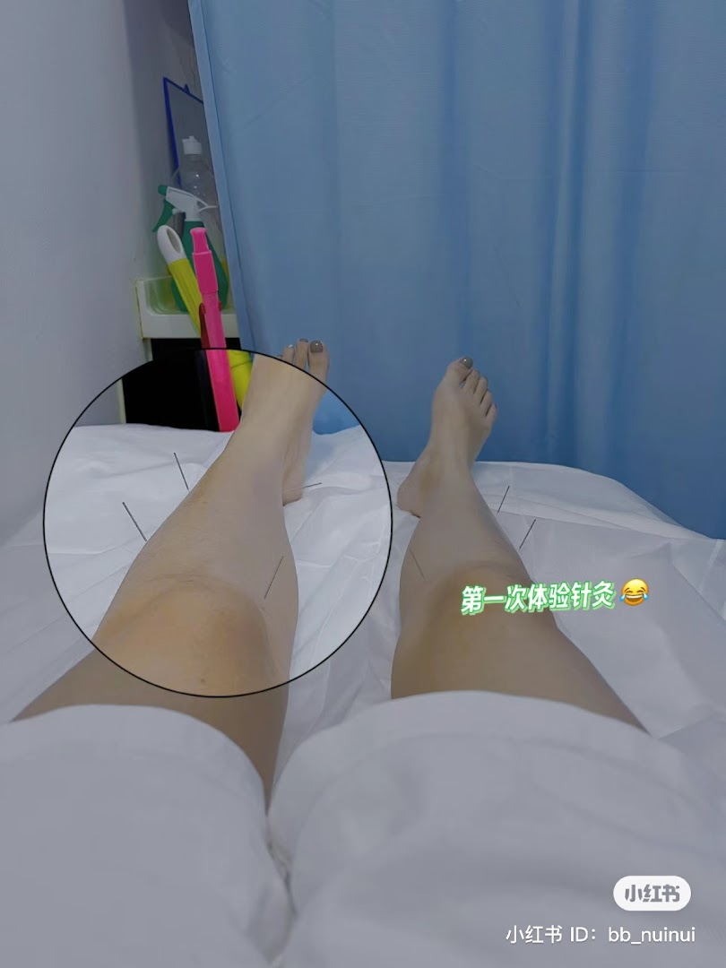 A patient's legs undergoing acupuncture treatment at a Traditional Chinese Medicine clinic.