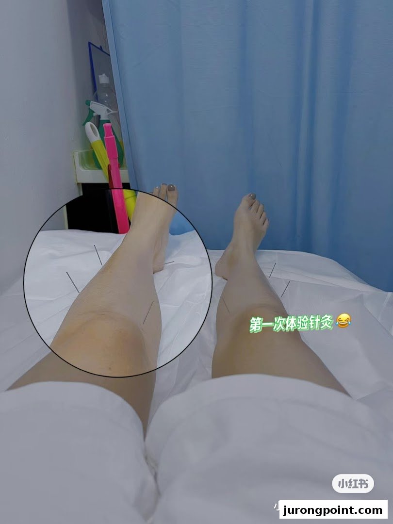 A patient's legs undergoing acupuncture treatment at a Traditional Chinese Medicine clinic.
