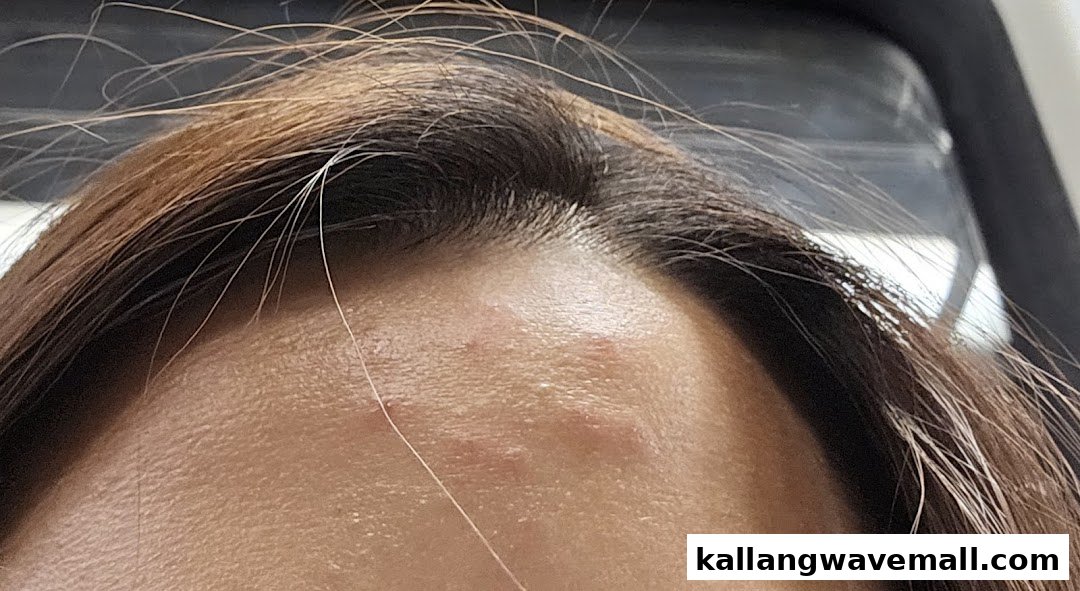A close-up of a person's forehead showing skin imperfections and hair.