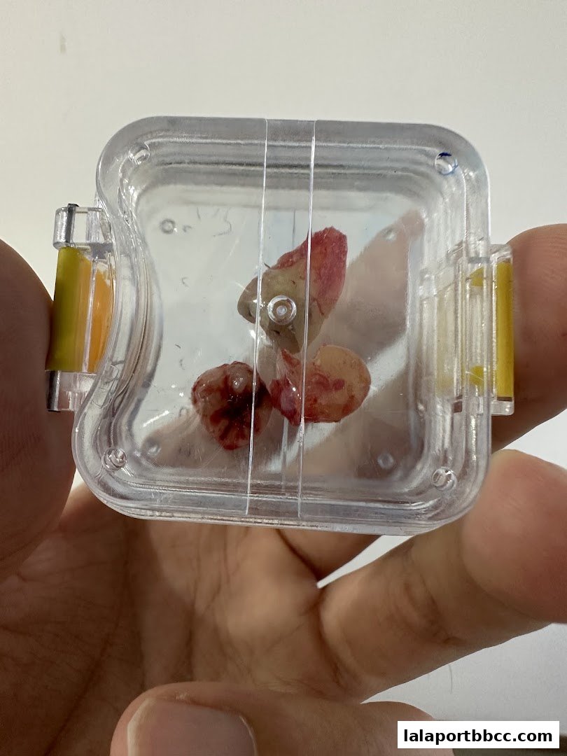 A person holds a clear plastic container with dental calculus samples inside.