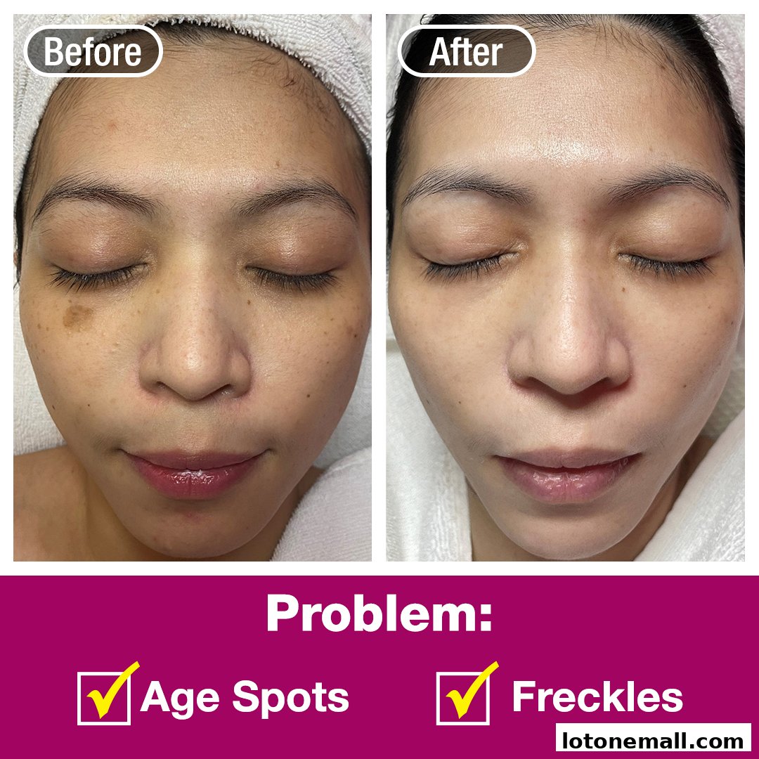 Before and after images showing a woman's face treated for age spots and freckles.