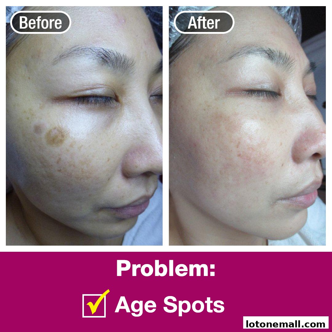 Before and after images showing treatment for age spots on a woman's face.