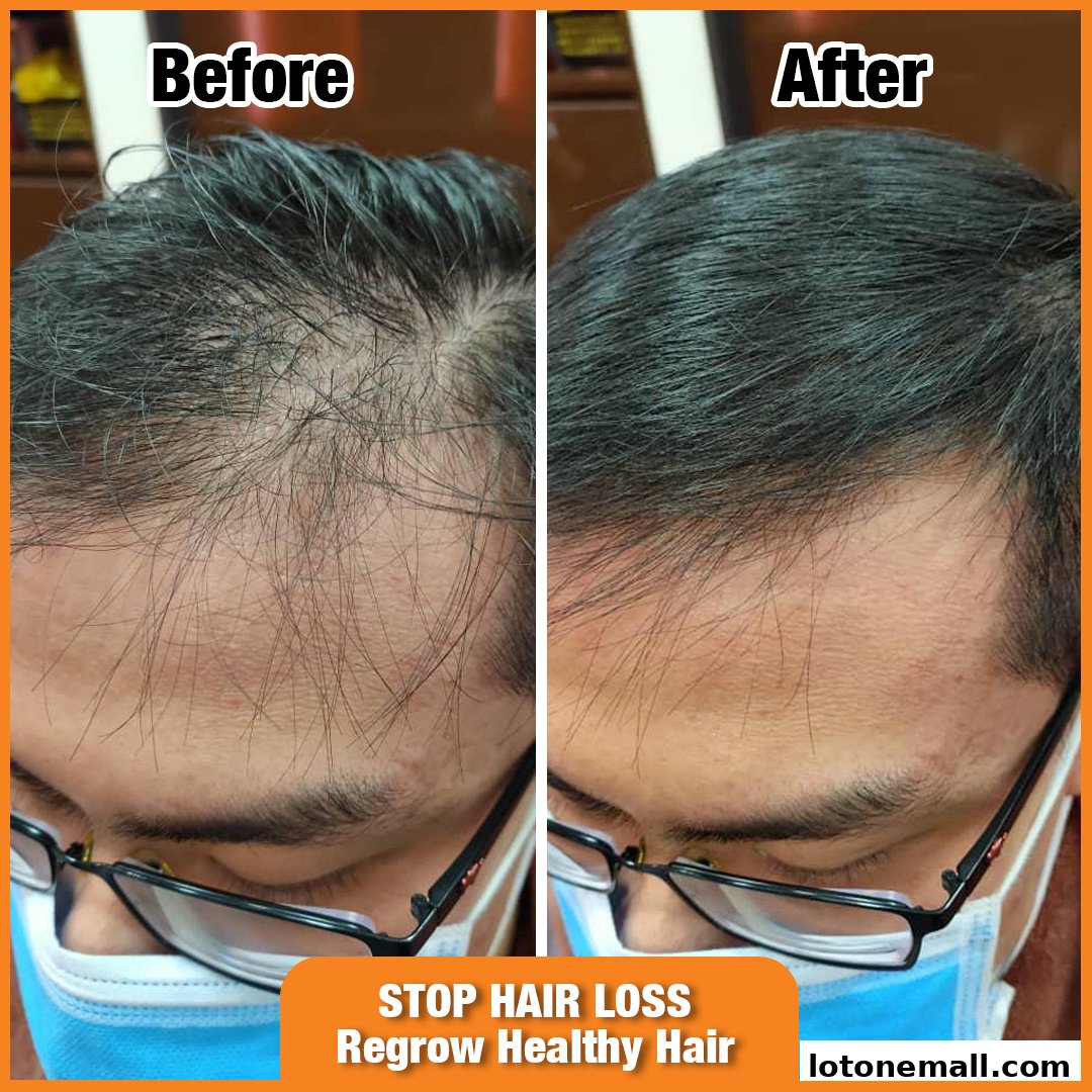 Before and after comparison of hair loss treatment showing significant hair regrowth.