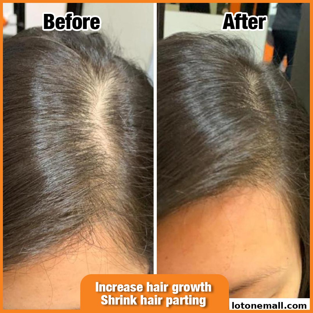 Before and after images showing hair growth and reduced parting for hair loss treatment.