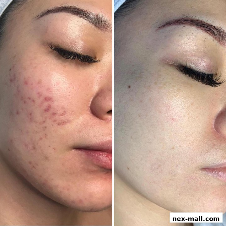 A split image showing a before and after comparison of facial skin treatment for acne and pigmentation.